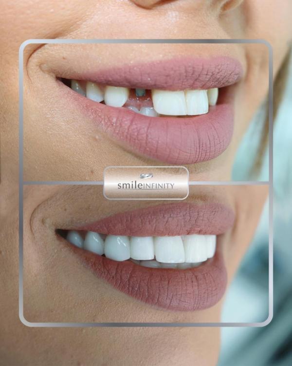 Dental implant crown before and after: a missing upper lateral tooth replaced so the smile line reads as natural — Smile Infinity® Beirut case