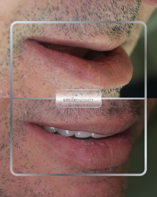 Implants dentaires posés en piézochirurgie, avant/après : une arcade inférieure effondrée restaurée par des dents sur implants — Dr. Habib Zarifeh, Beyrouth