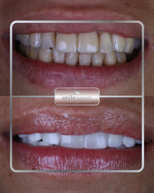 IPS e.max® ceramic veneers before and after: discoloured, uneven upper teeth restored to a natural white smile — Smile Infinity® case