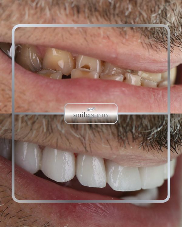 IPS e.max® ceramic veneers before and after on worn, discoloured upper teeth — Smile Infinity® Beirut case