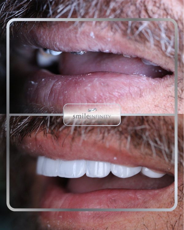 Full-arch dental implant rehabilitation before and after: an edentulous upper jaw restored with a fixed implant-supported bridge — Dr. Habib Zarifeh, Beirut
