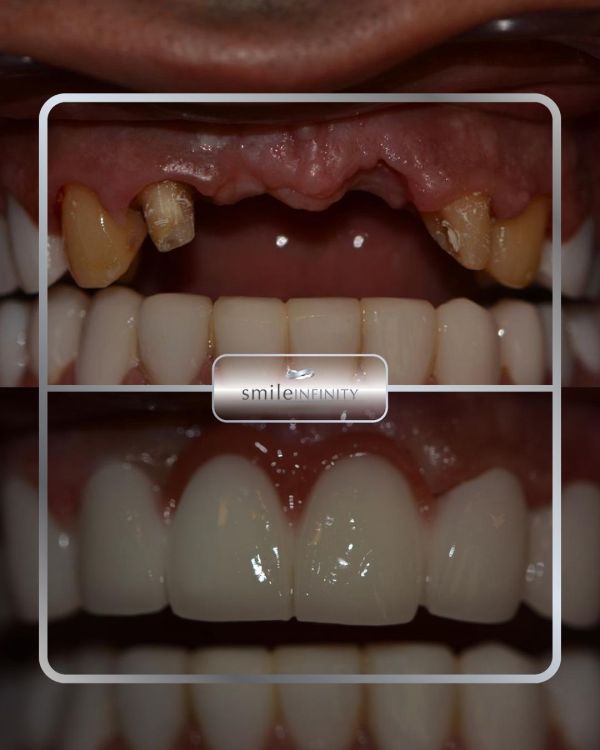 Full-mouth rehabilitation before and after: failing front teeth and missing teeth replaced with implants and ceramic restorations — Smile Infinity® Beirut case