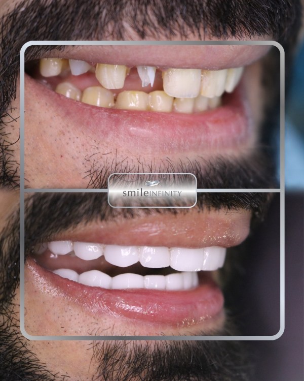 Full-arch Hollywood Smile veneers before and after: gaps, wear and discolouration corrected across the upper arch — Smile Infinity® Beirut case