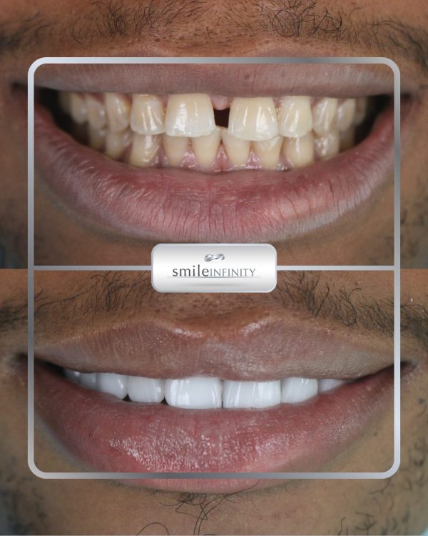 Hollywood Smile veneers before and after: spaced, uneven upper teeth closed and aligned in one stay — Smile Infinity® Beirut case
