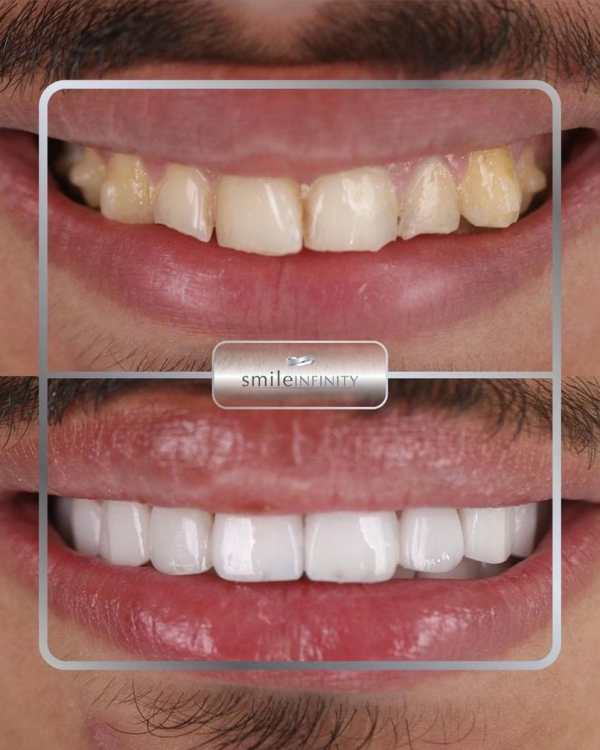 Lumineers® veneers before and after: stained, worn upper teeth brightened and reshaped without drilling — Dr. Habib Zarifeh, Beirut