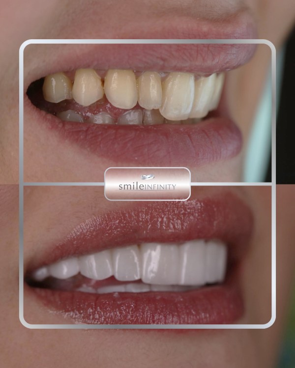 No-prep veneers before and after: yellowed, worn upper teeth transformed into a bright Hollywood Smile without drilling — Smile Infinity® case