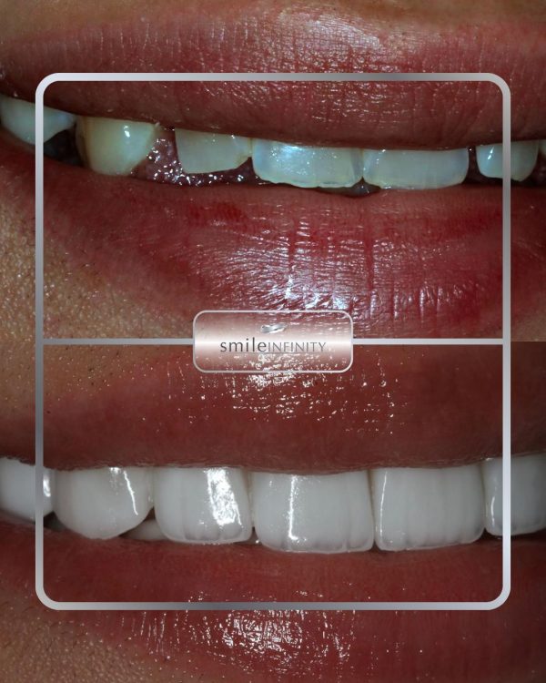 Porcelain veneers before and after: uneven, stained upper teeth replaced by a balanced white smile — Smile Infinity® Beirut case