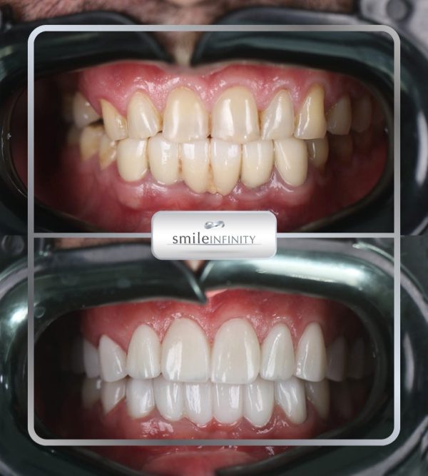 Clinical retractor view before and after porcelain veneers: discoloured, misaligned teeth restored to an even arch — Smile Infinity® Beirut case