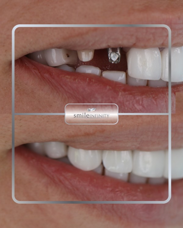 Implant unitaire avant/après : une dent supérieure manquante remplacée par une couronne céramique sur implant, assortie aux dents voisines — cas Smile Infinity®