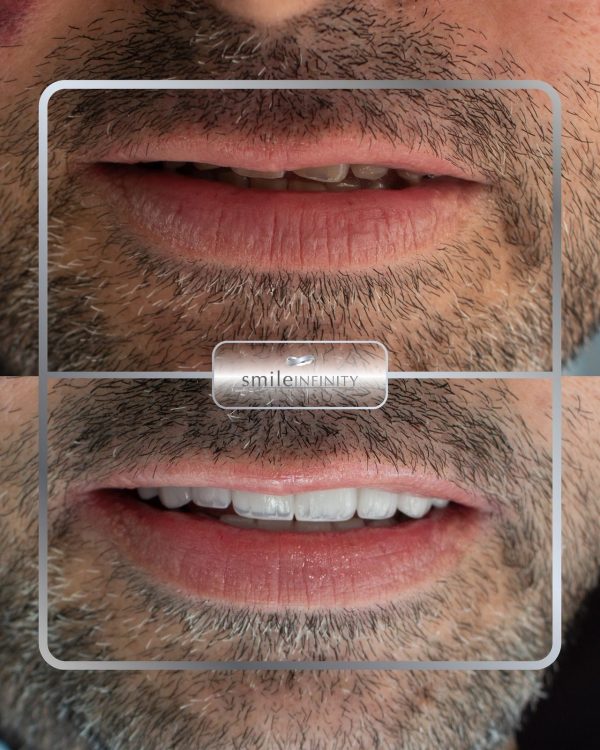 Smile transformation before and after: short, uneven upper teeth rebuilt into a fuller, brighter smile — Smile Infinity® Beirut case