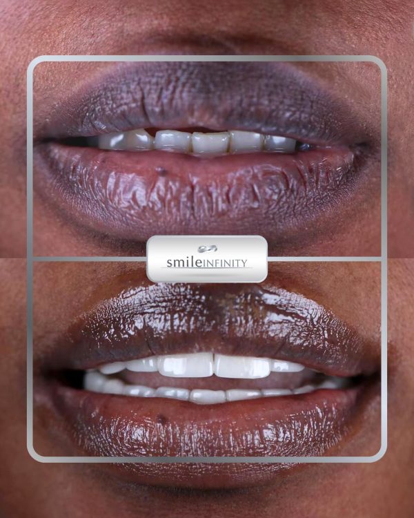 ZEvolution® Veneers before and after: closed gaps and a brighter smile designed for the patient’s natural lip and gum tones — Smile Infinity® Beirut case